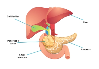 Pancreatic-Cancer-resized.jpg